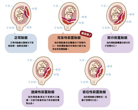 測字測驗 低位性前置胎盤